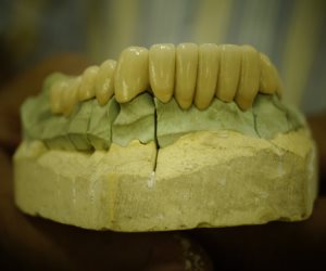 التفاصيل الكاملة عن «زراعة الأسنان» في (س & ج)