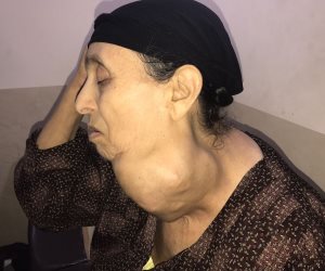 معهد جنوب مصر للأورام يجري عملية جراحية دقيقة لاستئصال ورم سيدة مسنة