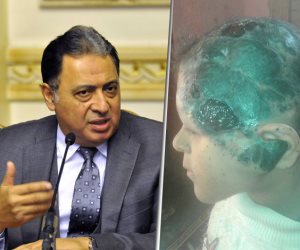 ولاء طفلة تعانى من تجمع دموي فى وجهها: «بتكسف من نظرة صحابي» (صور) 