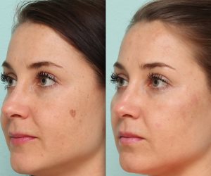 علاج البقع واستخدام قناع الطين.. 8 طرق لمواجهة حبوب الوجه للكبار