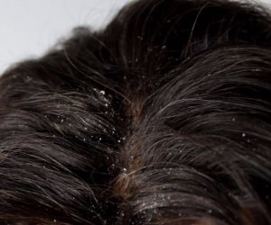 3 طرق لعلاج قشرة الشعر بالمنزل.. السر في الخل
