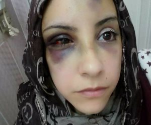 "تحدت أهلها من أجله فشوه وجهها بعد الطلاق".. إسراء نموذجاً للعنف ضد المرأة (صور)