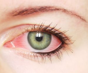 لو بتعاني من احمرار العينين إليك أهم الأسباب وطرق العلاج
