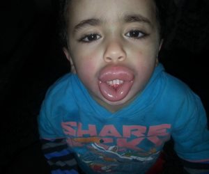  تورم وجه طفل لتناوله مادة غذائية منتهية الصلاحية بكفر الشيخ  