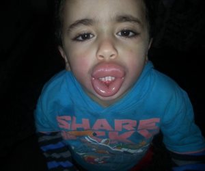 شيبسي بالنمل ..تورم وجه طفل لتناوله مادة غذائية منتهية الصلاحية بكفر الشيخ  
