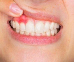 لتورم اللثة أسباب أخرى بعيدة عن الأسنان.. أهمها التغيرات الهرمونية