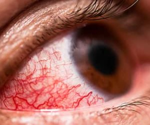 حافظ على نعمة البصر.. طرق طبيعية للقضاء على التهابات العين وجفافها