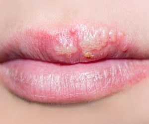 منها الحساسية والالتهاب.. أسباب جفاف الجلد حول الفم