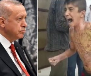 بالفسفور الأبيض والنابلم.. الديكتاتور التركي ينهش أجساد أطفال شمال سوريا