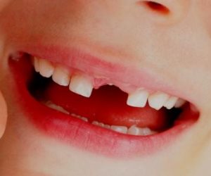فقدان الأسنان اللبنية.. متى يبدأ الطفل فقدانها وما يجب على الأم فعله