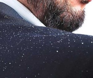 بالصبار والبيكينج باودر.. أبسط وصفات طبيعية للتخلص من قشرة الشعر 