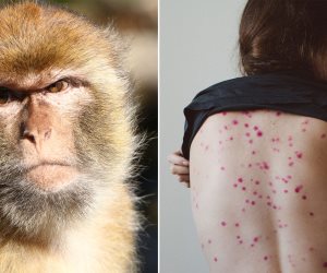 الصحة الفرنسية تعلن إصابة ما يقرب من 1700 شخص بجدرى القرود فى البلاد