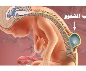 ما هو مرض الصلب المشقوق.. بعد حالة زوجي الهانوفيل