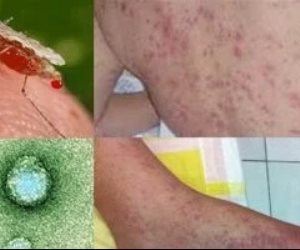 فيروس شيكونونيا .. تعرف علي المرض الصينى الجديد الذي أثار القلق عالميًا