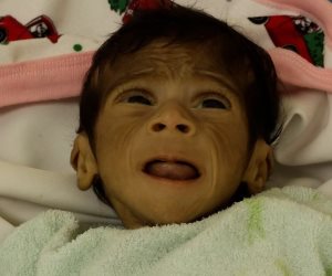  289 شهيدا بينهم 115 طفلا ضحايا المجاعة وسوء التغذية فى غزة.. واليونيسيف تحذر : شاهدنا أطفال بأجساد هزيلة ضعفاء لا يستطيعون البكاء أو الأكل