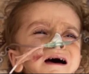 مأساة الطفل كريم معمر.. سوء التغذية يتسبب في تضخم بالكبد ولا أدوية بمستشفيات غزة