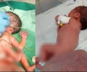 رضيعة فى غزة تصاب بتشوه خلقي لاستنشاق الأم غازات سامة