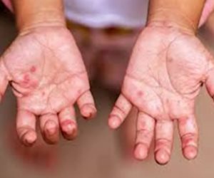 التفاصيل الكاملة لظهور فيروس HFMD بين عدد من طلاب مدرسة فى الجيزة
