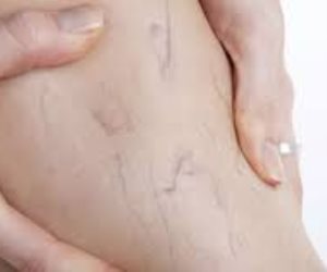 3 خطوات لحماية صحة الساقين من الأصابه بالدوالي