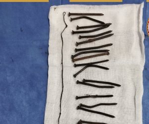 تفاصيل إنقاذ سيدة ابتلعت 34 مسمارًا منذ 45 يوما في كفر الشيخ