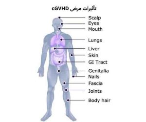 مرض الطرد العكسي المزمن.. التحدي الصامت بعد زراعة الخلايا الجذعية في مصر