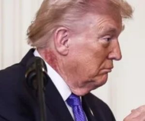 طفح جلدي برقبة ترامب يثير تساؤلات.. وأطباء يرجّحون إصابته بالتقرن السفعي