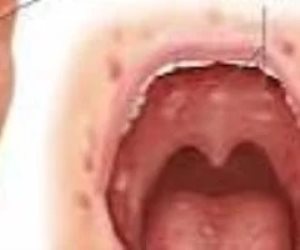 حدث في عاصمة بيرو.. تعليق الدراسة بسبب انتشار فيروس كوكساكى 