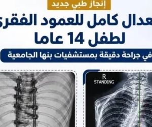 إنجاز طبى بمستشفيات جامعة بنها  .. استعدال كامل للعمود الفقرى لطفل 14 عامًا 