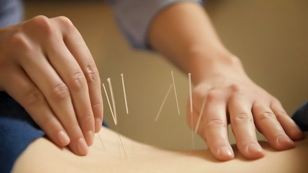 الوخز بالإبر يخفّف أعراض سن اليأس