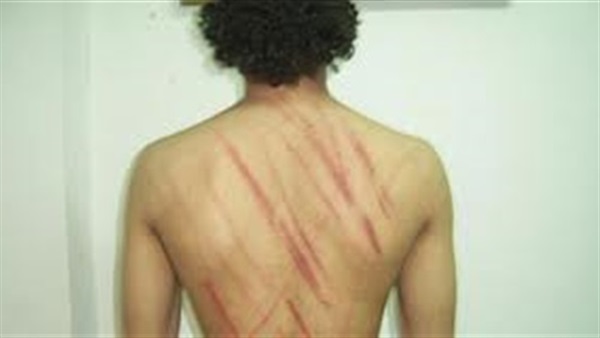 بالصور.. قصة مآساوية لمواطن تعرض للتعذيب على يد مقاول بالإسكندرية.. رفض مخالفة القانون وبناء أدوار مخالفة.. «المقاول» يتهجم على منزله ويعتدى علية بالسلاح.. وحرق مناطق حساسة بجسده أمام أسرتة 