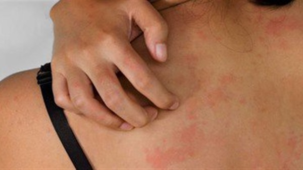 4 حلول منزلية لعلاج الطفح الجلدي
