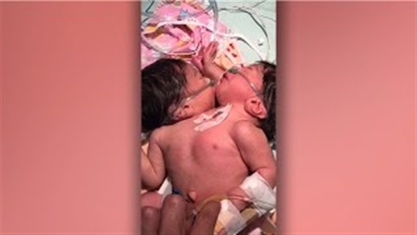 بالفيديو..توءم ملتصق من البطن ولهما قلب واحد