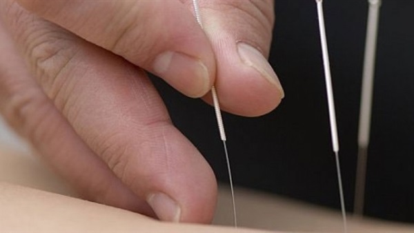 أطباء بريطانيون يكتشفون إبرة منسية فى أحشاء رجل منذ 40 عاما