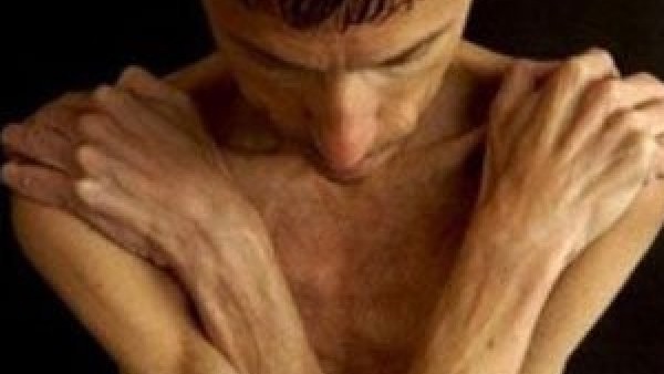 دراسة: فقد الوزن بنسب كبيرة يزيد من مخاطر الإصابة بالزهايمر