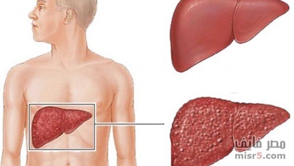 6 إجراءات سهلة لتنظيف الكبد من السموم