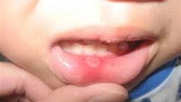 ضمادة سائلة لعلاج بثور الفم واللسان في فرنسا