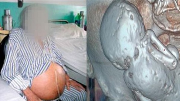 عجوز جزائرية تحمل جنينا عمره 35 سنة