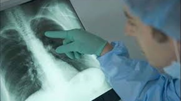 طفرة في علاج سرطان الرئة تركز على تنشيط الجهاز المناعي 