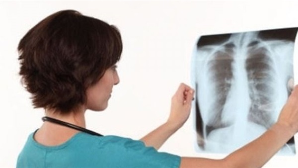 أمل جديد لمرضى «السل المقاوم»