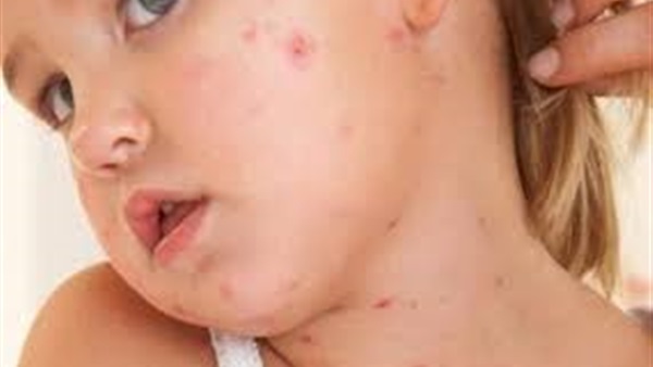 تقرير: اللقاح ضد الحصبة أنقذ حياة 20 مليون شخص منذ عام 2000