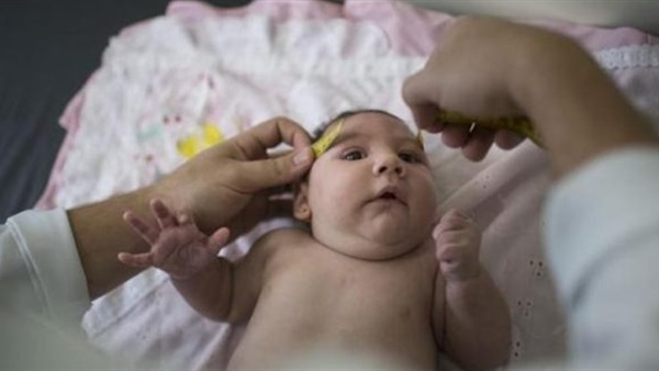 دراسة: أطفال «زيكا» أصيبوا بصغر حجم الرأس بعد الولادة