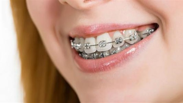 هكذا تنظف أسنانك أثناء مرحلة التقويم