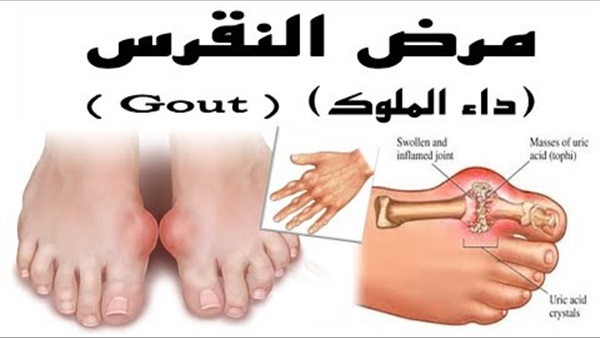 تعرف على أهم علامات مرض النقرس والأدوية المناسبة لتخفيف الألم