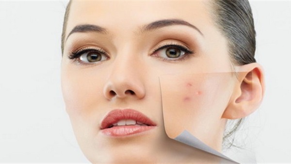 طرق طبيعية تساهم في التخلص من حب الشباب 