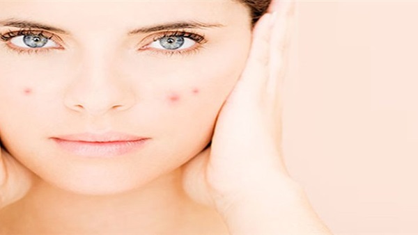 طرق سهلة لعلاج حب الشباب.. تعرف عليها