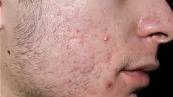 نقص الأوكسجين يؤدى لتكاثرالبكتيريا المسببة لحب الشباب