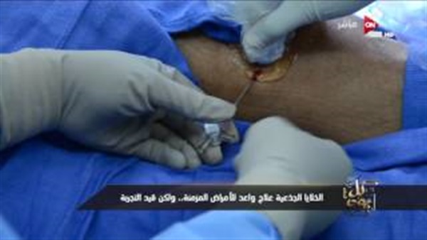 عمرو أديب يعرض تقرير للعلاج بالخلايا الجذعية (فيديو)