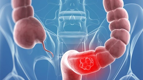 دراسة: النحافة الزائدة تسبب سرطان الأمعاء