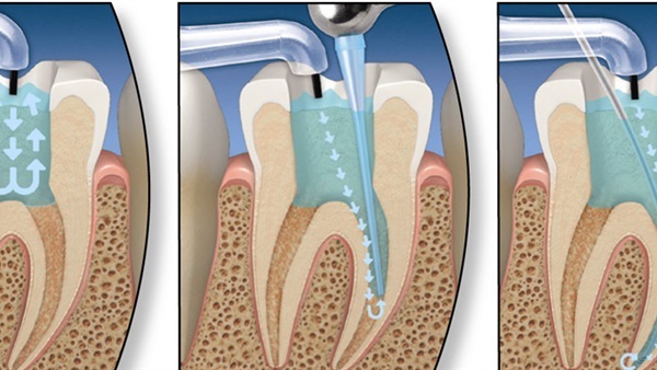 باحثون يطورون علاجا لجذور الأسنان