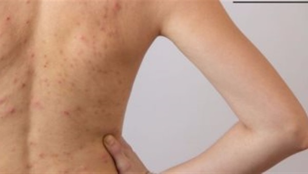 طرق علاج حب الشباب بمنطقة الظهر.. تعرفوا عليها